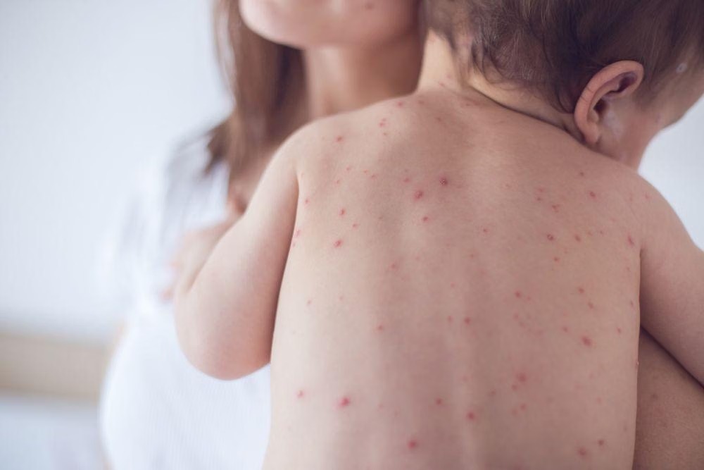 Mitos atau Fakta: Anak Kena Cacar Air Tidak Boleh Mandi?