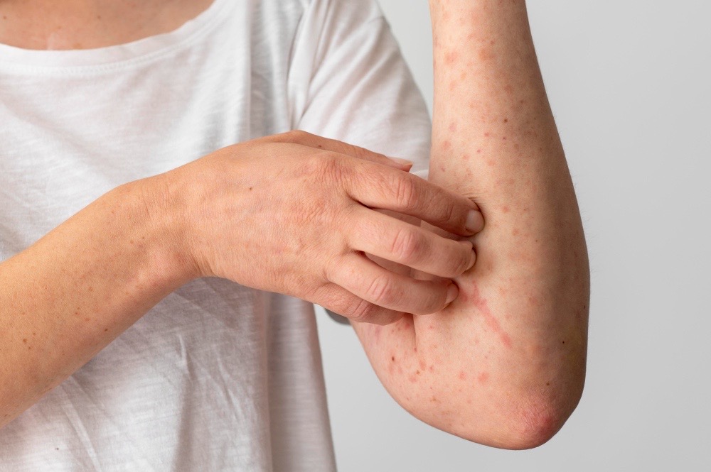 Kulit Mendadak Bentol Merah setelah Ditekan atau Digores? Kenali Dermatographism