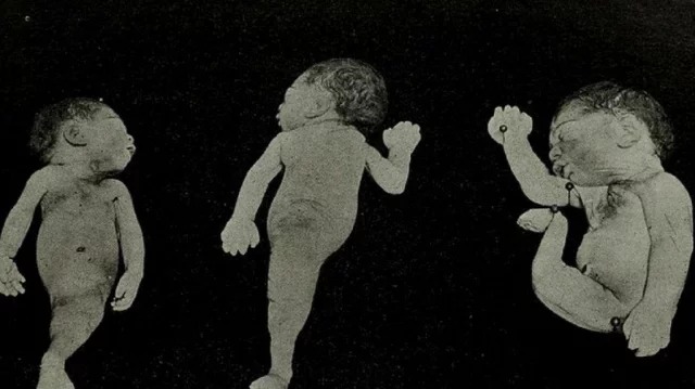 Mengenal Sirenomelia atau Sindrom Putri Duyung pada Bayi Baru Lahir
