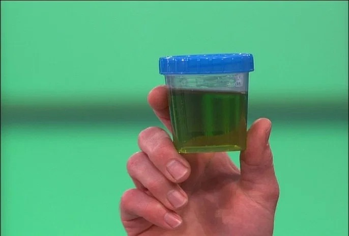 Viral Urine Berwarna Hijau, Apa Artinya? Ini Kata Urolog
