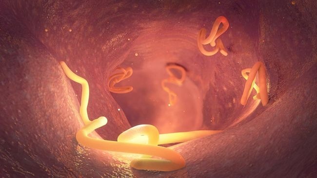 Mengidap Neurocysticercosis, 38 Parasit Bersarang di Otak Wanita Ini