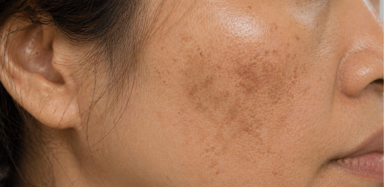 Lebih dari 90% Penderita Melasma adalah Perempuan, Ini Penyebabnya