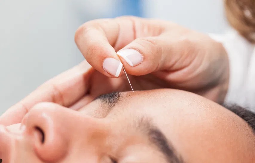 Tren Baru! Akupuntur Wajah Jadi Alternatif Botox Tanpa Suntik