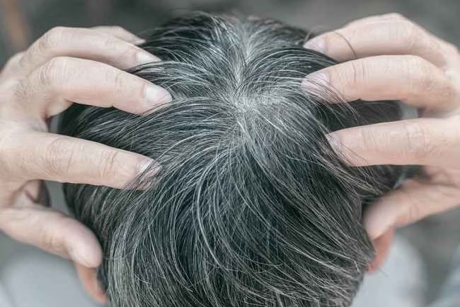 Riset: Stres Bisa Bikin Rambut Beruban hingga Berwarna Lagi