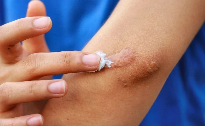 Jangan Cuma Ditunggu Kering! Ini Cara Mencegah Bekas Luka Kata Dokter Kulit
