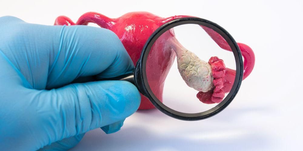 Dokter Sebut Kebiasaan Ini Bisa Picu Kista Ovarium
