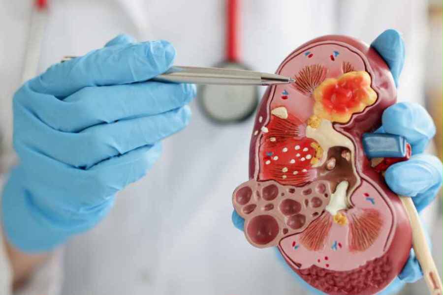 Ahli Temukan Silent Killer Baru, Mulai Banyak Menyerang Anak Muda