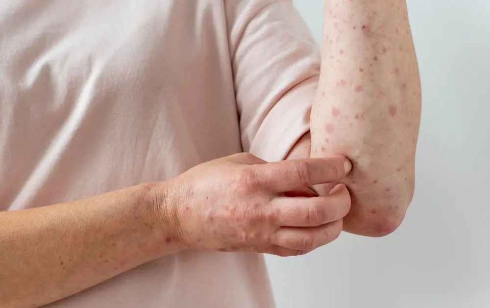 Tak Cuma Anak, Campak pada Orang Dewasa Bisa Picu Komplikasi Serius