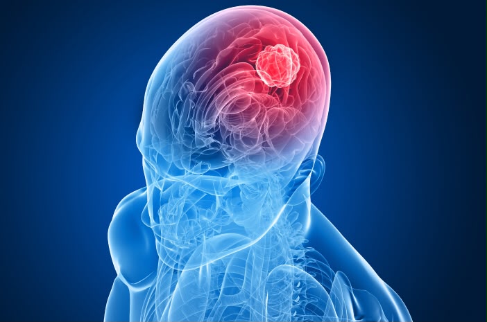 Kisah Wanita Idap Tumor Otak Ganas, Gejala Awalnya Sering Dikira Anxiety